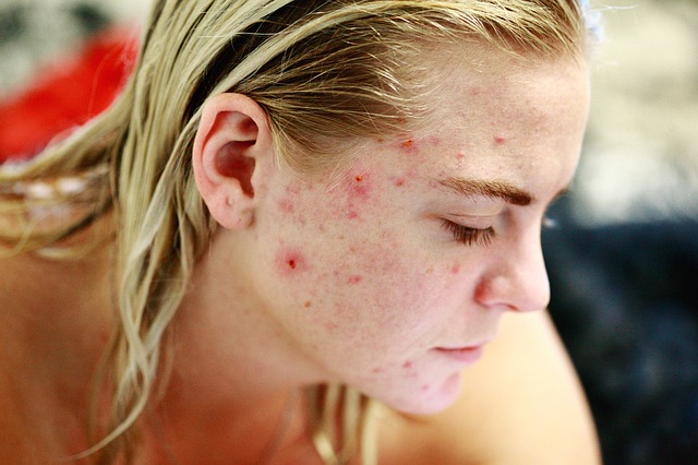 Awesome Advice For Clearing Up Your Acne!