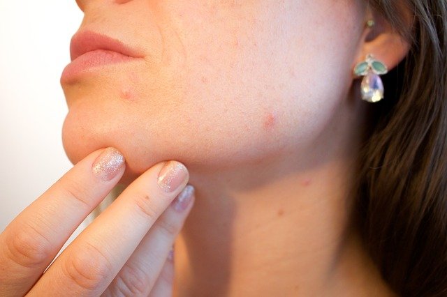 The Best Acne Advice You Can Read